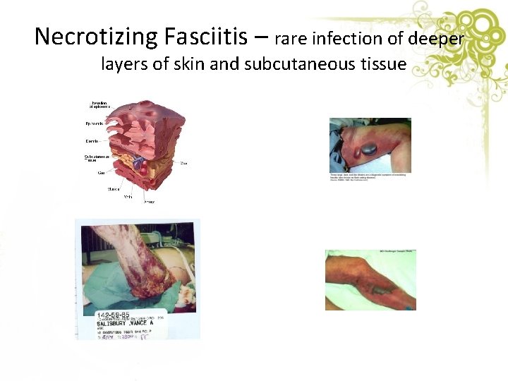 Necrotizing Fasciitis – rare infection of deeper layers of skin and subcutaneous tissue 