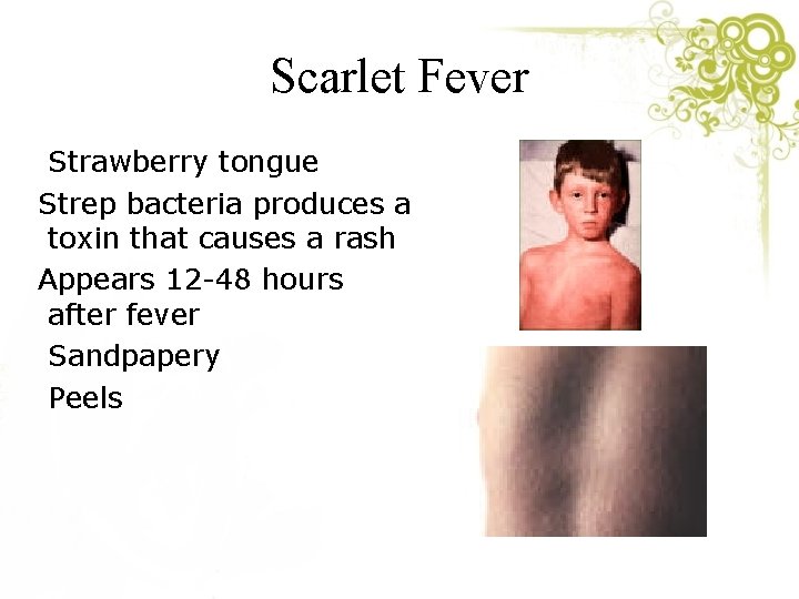 Scarlet Fever Strawberry tongue Strep bacteria produces a toxin that causes a rash Appears