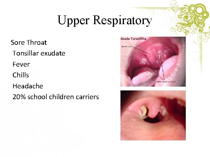 Upper Respiratory Sore Throat Tonsillar exudate Fever Chills Headache 20% school children carriers 