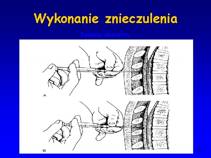 Wykonanie znieczulenia Podanie depozytu MŁ 