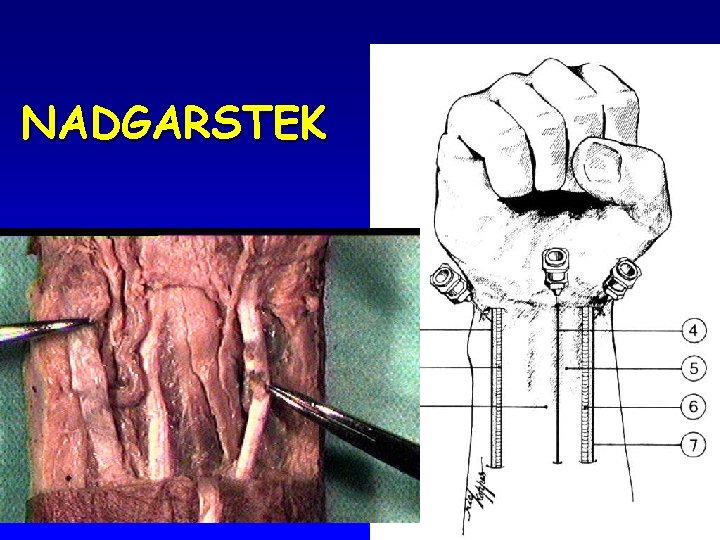 NADGARSTEK 