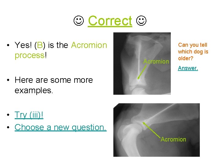  Correct • Yes! (B) is the Acromion process! Acromion Can you tell which