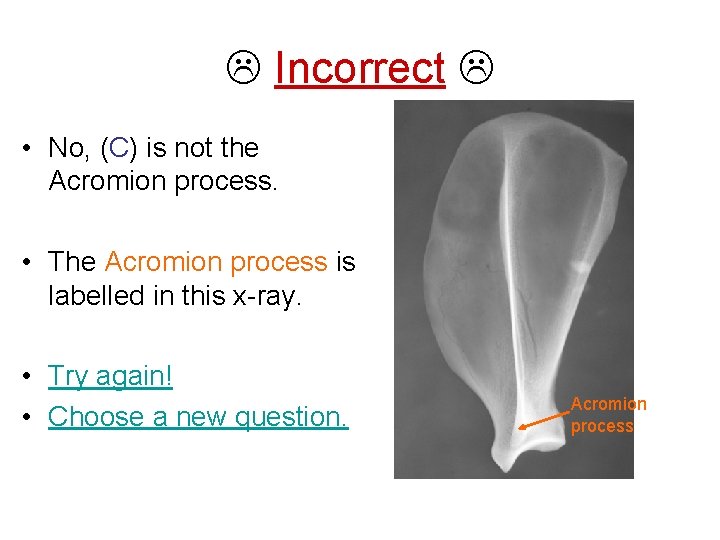  Incorrect • No, (C) is not the Acromion process. • The Acromion process