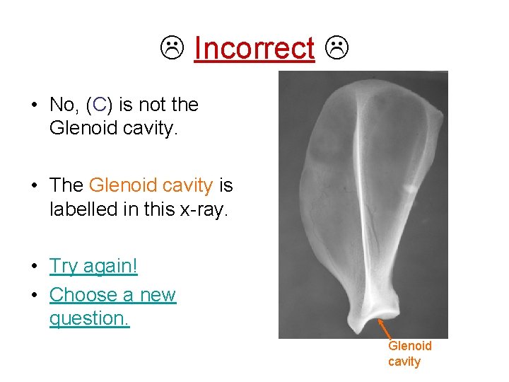  Incorrect • No, (C) is not the Glenoid cavity. • The Glenoid cavity