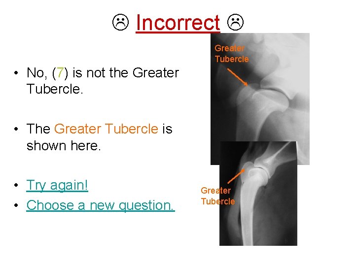  Incorrect Greater Tubercle • No, (7) is not the Greater Tubercle. • The