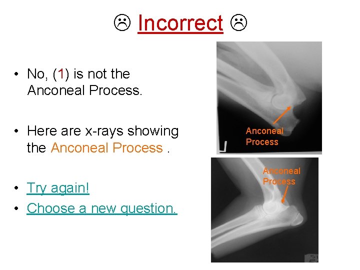  Incorrect • No, (1) is not the Anconeal Process. • Here are x-rays