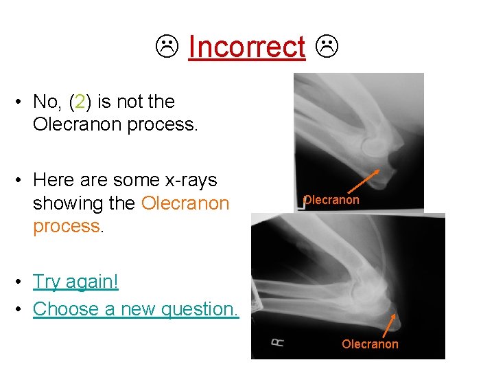  Incorrect • No, (2) is not the Olecranon process. • Here are some