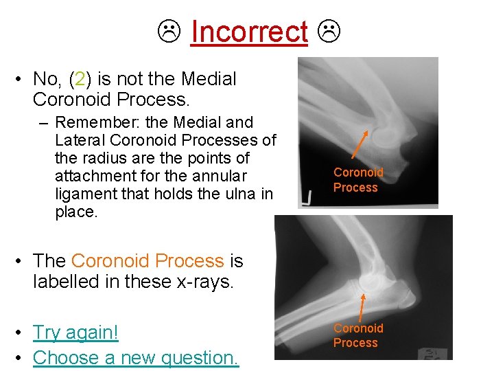  Incorrect • No, (2) is not the Medial Coronoid Process. – Remember: the