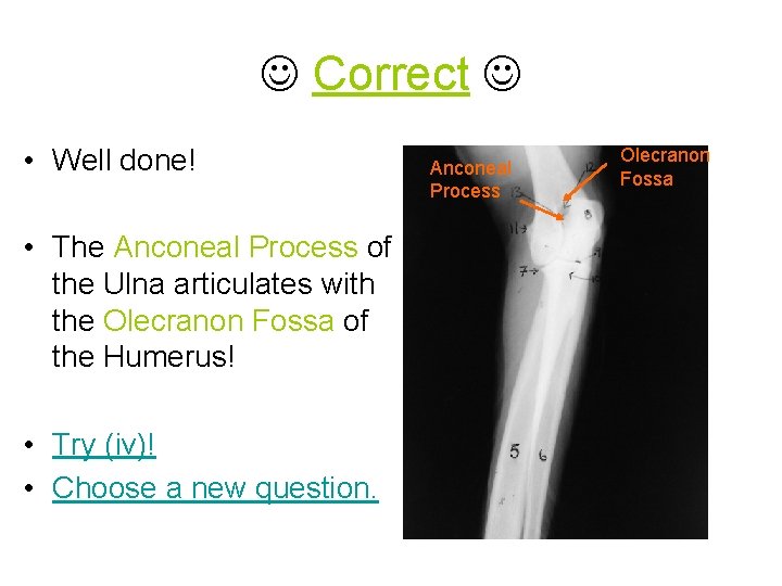  Correct • Well done! • The Anconeal Process of the Ulna articulates with