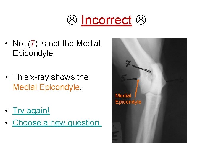  Incorrect • No, (7) is not the Medial Epicondyle. • This x-ray shows