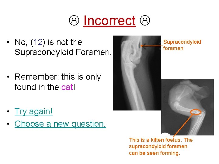  Incorrect • No, (12) is not the Supracondyloid Foramen. Supracondyloid foramen • Remember: