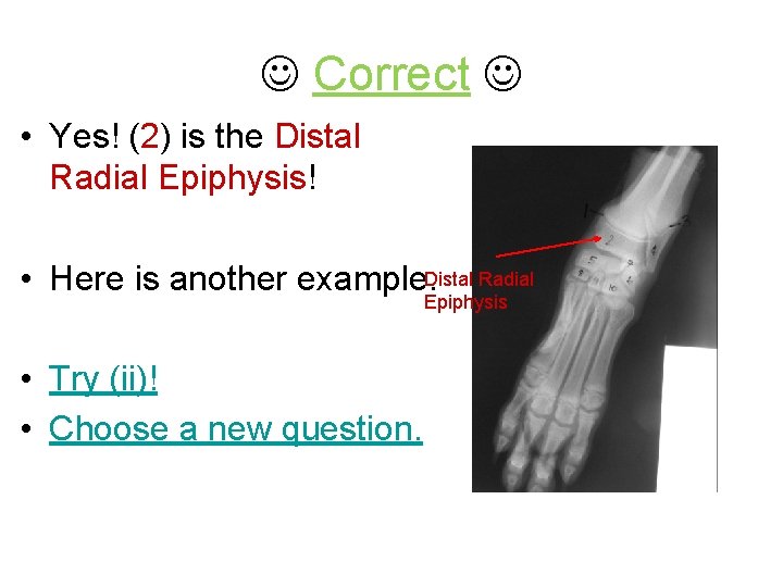  Correct • Yes! (2) is the Distal Radial Epiphysis! • Here is another