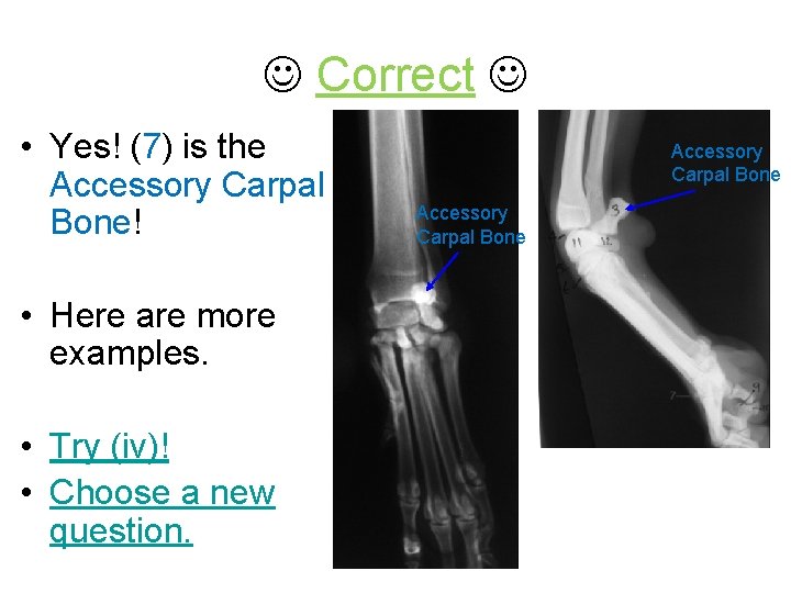  Correct • Yes! (7) is the Accessory Carpal Bone! • Here are more