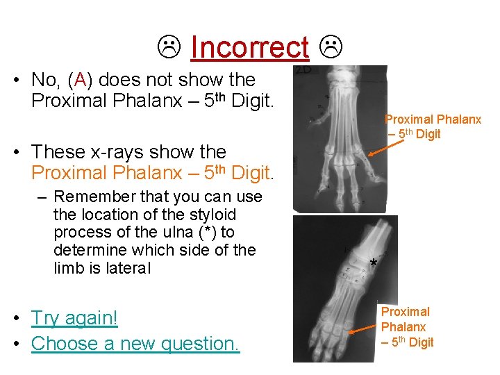  Incorrect • No, (A) does not show the Proximal Phalanx – 5 th