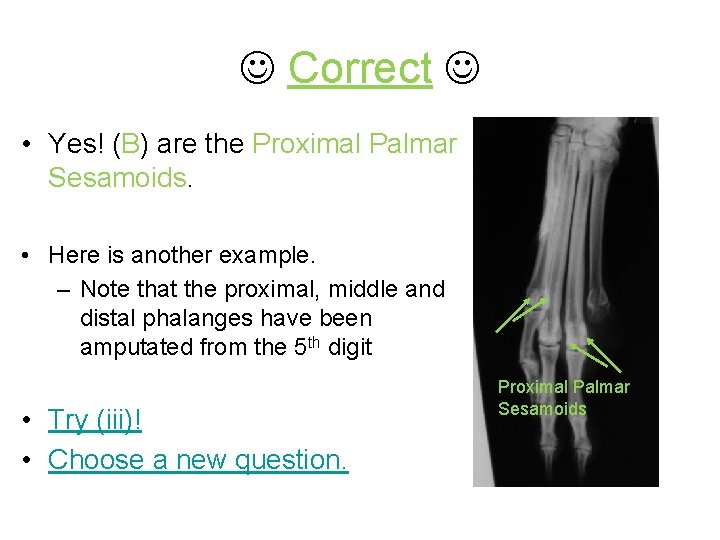  Correct • Yes! (B) are the Proximal Palmar Sesamoids. • Here is another