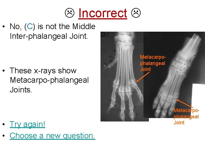  Incorrect • No, (C) is not the Middle Inter-phalangeal Joint. • These x-rays