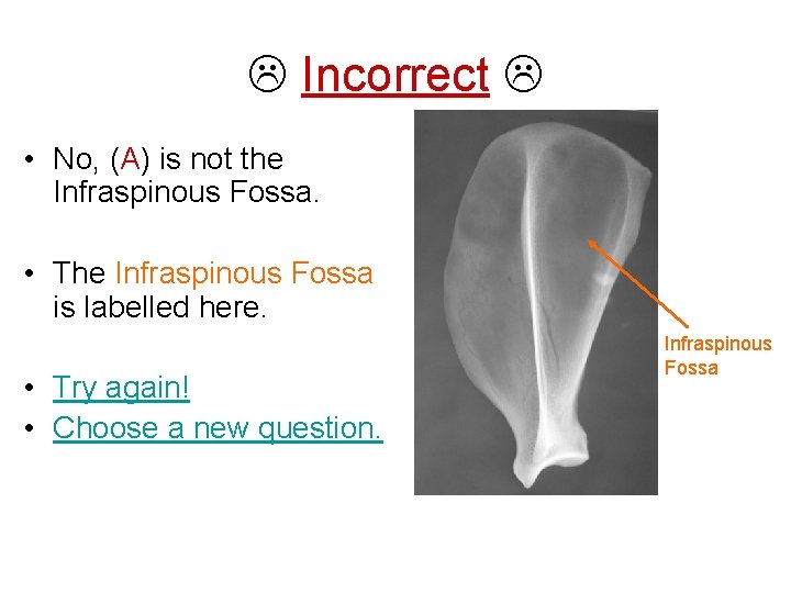  Incorrect • No, (A) is not the Infraspinous Fossa. • The Infraspinous Fossa