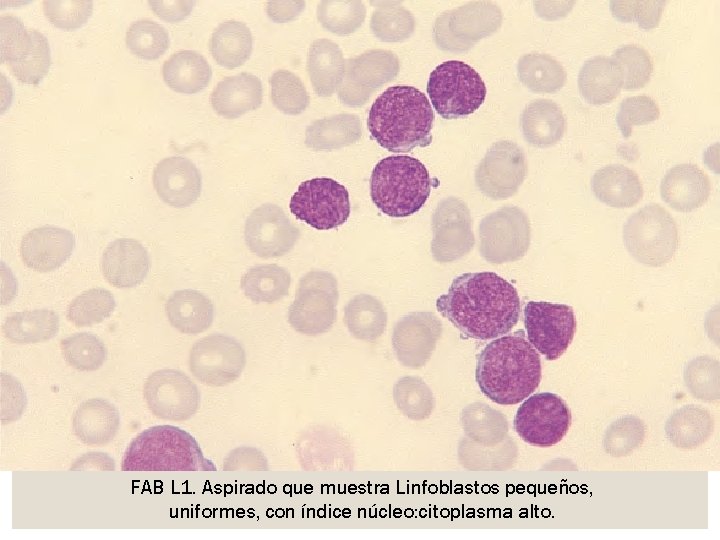 FAB L 1. Aspirado que muestra Linfoblastos pequeños, uniformes, con índice núcleo: citoplasma alto.