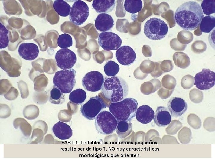 FAB L 1. Linfoblastos uniformes pequeños, resultó ser de tipo T, NO hay características