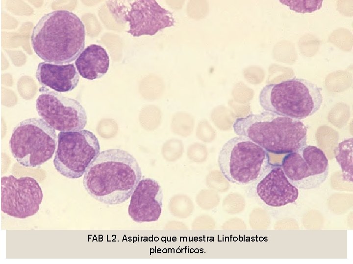 FAB L 2. Aspirado que muestra Linfoblastos pleomórficos. 