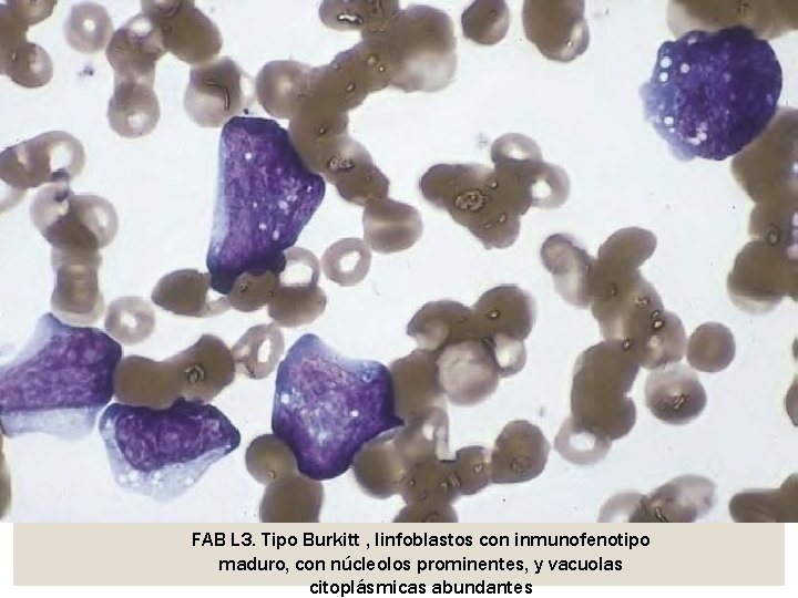 FAB L 3. Tipo Burkitt , linfoblastos con inmunofenotipo maduro, con núcleolos prominentes, y