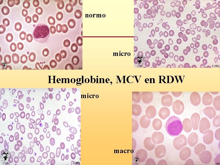 normo micro Hemoglobine, MCV en RDW micro macro 