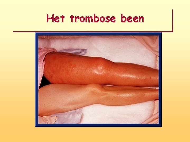 Het trombose been 