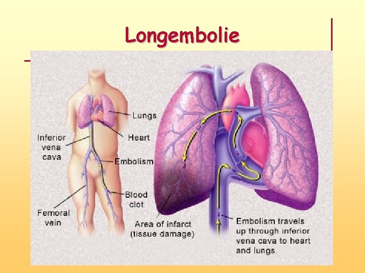 Longembolie 