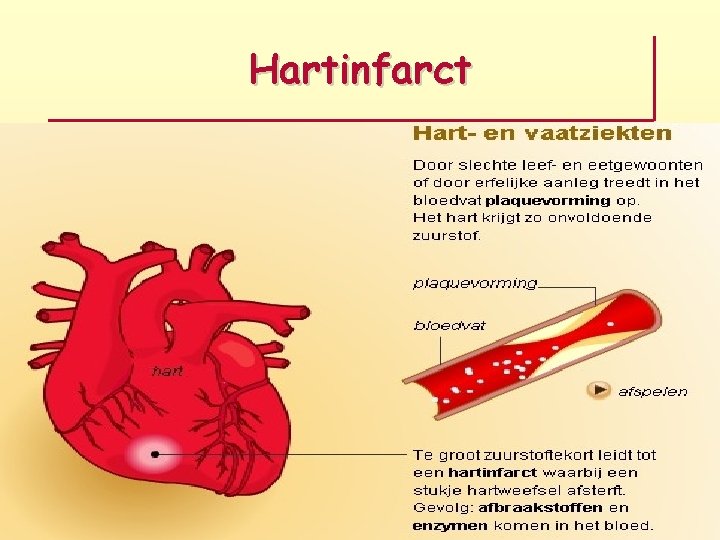 Hartinfarct 