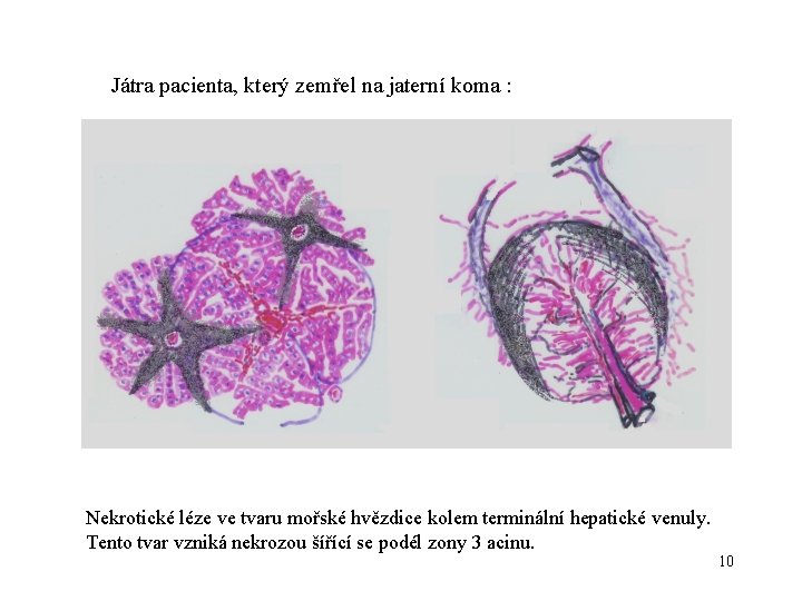 Játra pacienta, který zemřel na jaterní koma : Nekrotické léze ve tvaru mořské hvězdice