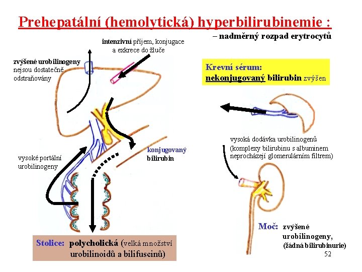 Prehepatální (hemolytická) hyperbilirubinemie : intenzivní příjem, konjugace a exkrece do žluče zvýšené urobilinogeny nejsou