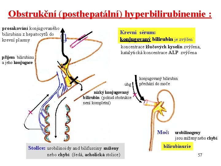 Obstrukční (posthepatální) hyperbilirubinemie : prosakování konjugovaného bilirubinu z hepatocytů do krevní plasmy Krevní sérum: