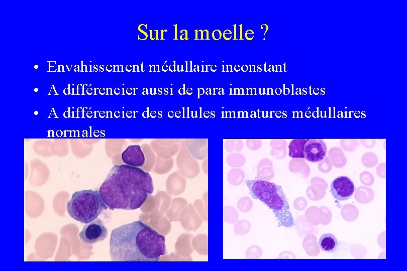 Sur la moelle ? • Envahissement médullaire inconstant • A différencier aussi de para