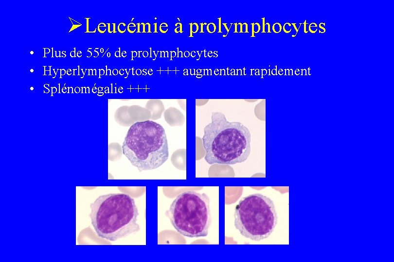 ØLeucémie à prolymphocytes • Plus de 55% de prolymphocytes • Hyperlymphocytose +++ augmentant rapidement