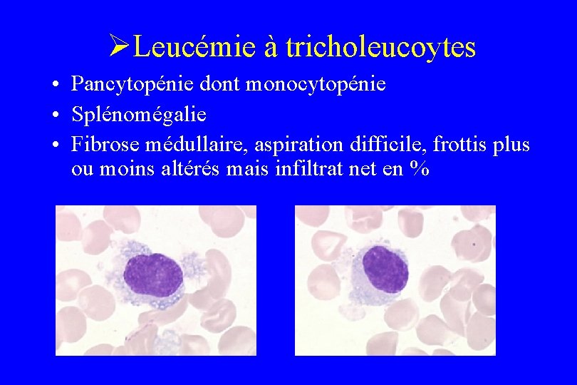 ØLeucémie à tricholeucoytes • Pancytopénie dont monocytopénie • Splénomégalie • Fibrose médullaire, aspiration difficile,