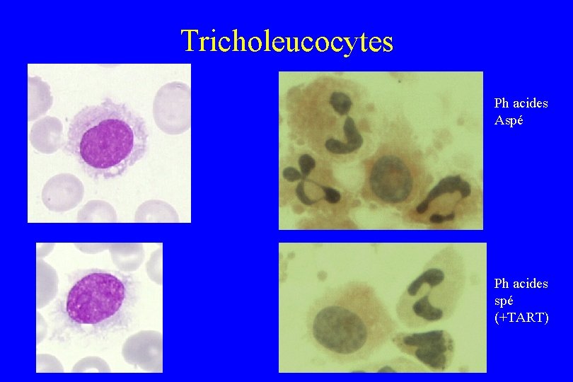 Tricholeucocytes Ph acides Aspé Ph acides spé (+TART) 