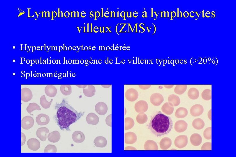 ØLymphome splénique à lymphocytes villeux (ZMSv) • Hyperlymphocytose modérée • Population homogène de Lc