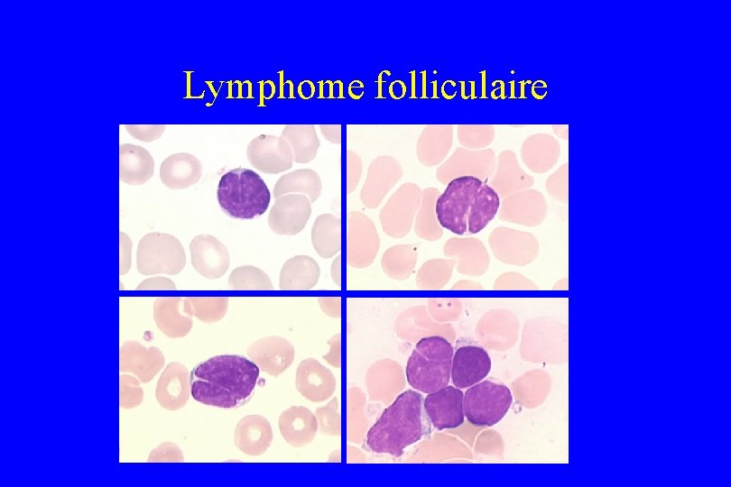 Lymphome folliculaire 