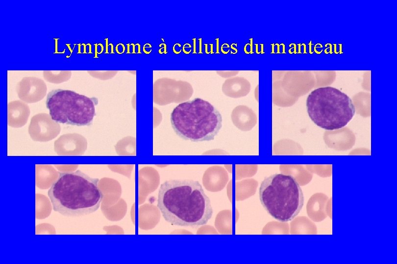 Lymphome à cellules du manteau 