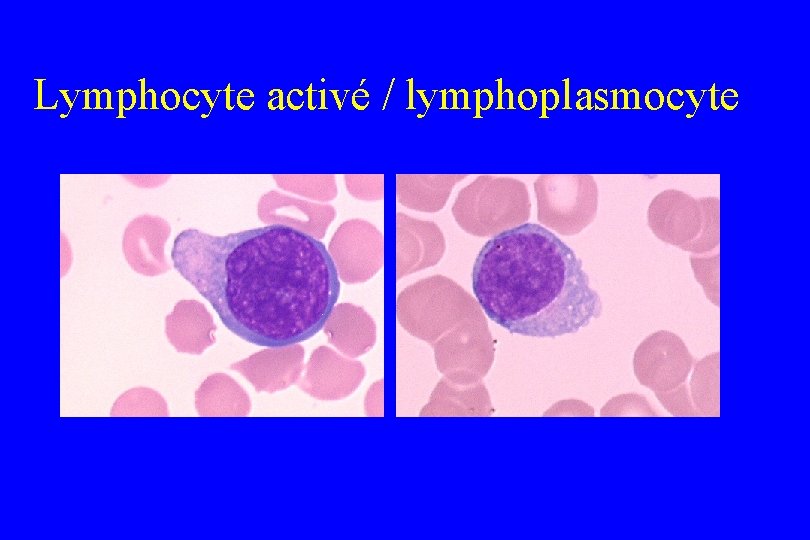 Lymphocyte activé / lymphoplasmocyte 