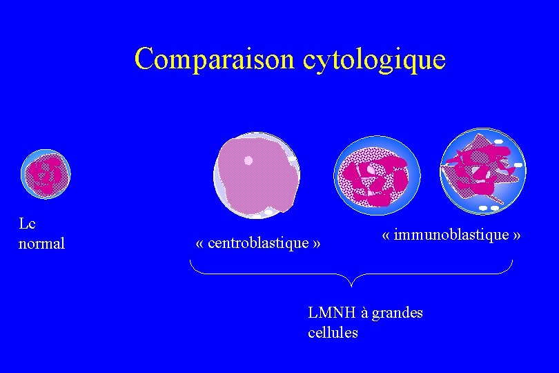Comparaison cytologique Lc normal « centroblastique » « immunoblastique » LMNH à grandes cellules
