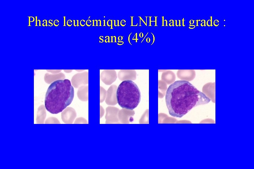 Phase leucémique LNH haut grade : sang (4%) 