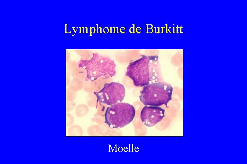 Lymphome de Burkitt Moelle 