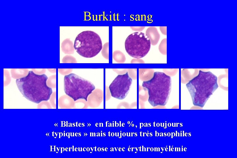 Burkitt : sang « Blastes » en faible %, pas toujours « typiques »