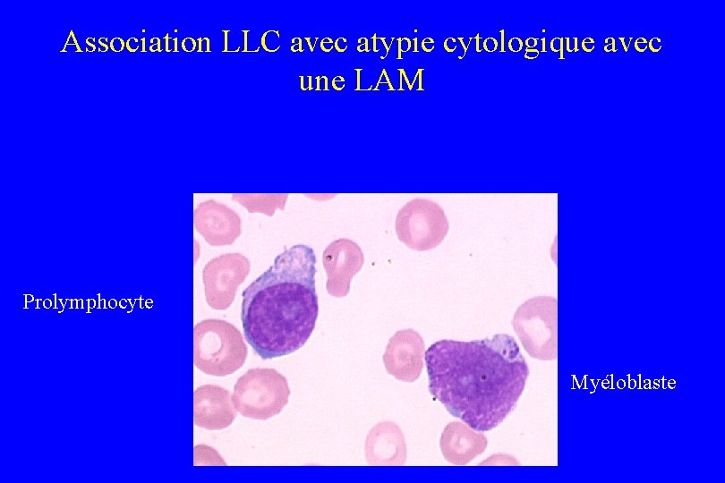 Association LLC avec atypie cytologique avec une LAM Prolymphocyte Myéloblaste 