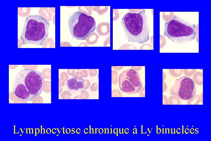  Lymphocytose chronique à Ly binucléés 