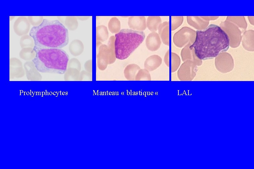 Prolymphocytes Manteau « blastique « LAL 