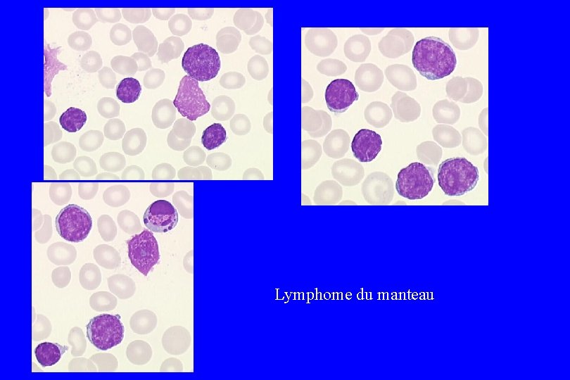 Lymphome du manteau 