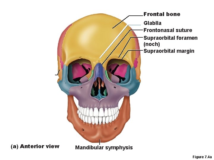 Frontal bone Glablla Frontonasal suture Supraorbital foramen (noch) Supraorbital margin (a) Anterior view Mandibular