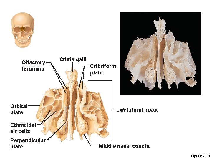 Olfactory foramina Orbital plate Crista galli Cribriform plate Left lateral mass Ethmoidal air cells